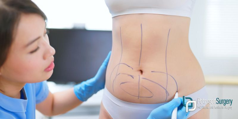 Tummy Tuck vs Liposuction: Which Procedure Delivers Better Results?